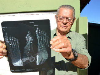 CHUMBOS ANTIGOS — Roberto Rocha, o “Pé de Chumbo”, mostra raio-X recente com os chumbos daquele tiro acidental que aconteceu há 68 anos